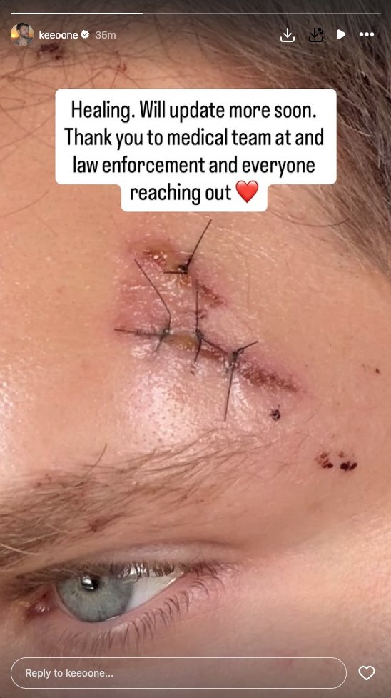 ‘Pretty Little Liars’ star Keegan Allen shows off battered, stitched-up face after brutal attack in LA